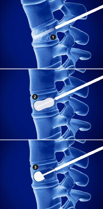 What Is A Kyphoplasty The Southeastern Spine Institute