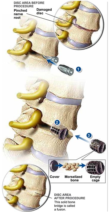 What Is A Lateral Lumbar Interbody Fusion Xlif The Southeastern