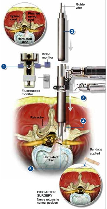 discectomy