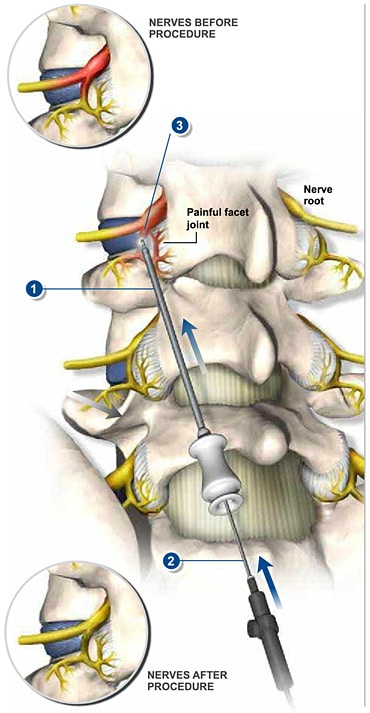 rhizotomy