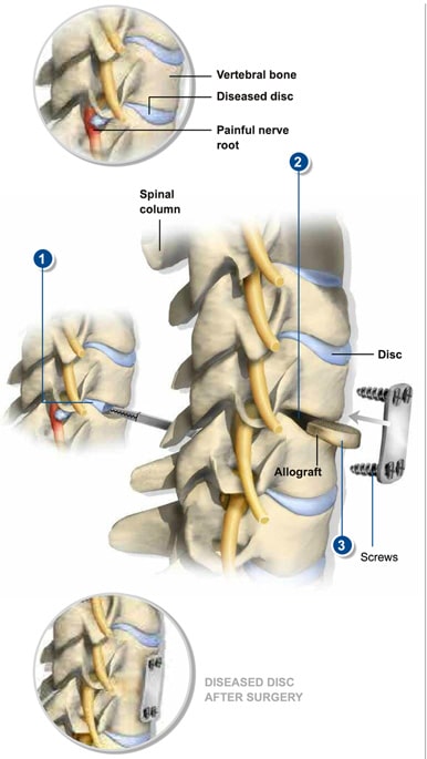 anterior-cervical-discectomy-fusion-the-southeastern-spine-institute