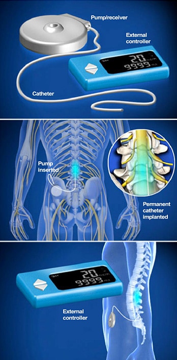 Intrathecal Pump Implant - The Southeastern Spine Institute