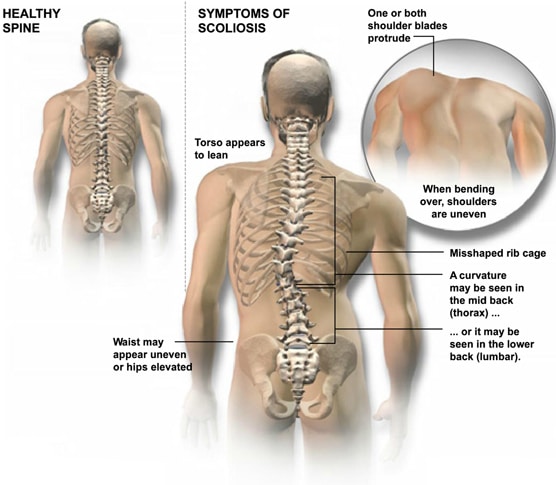 scoliosis spine curvature