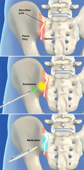 Sacroiliac Joint Steroid Injection | The Southeastern Spine Institute