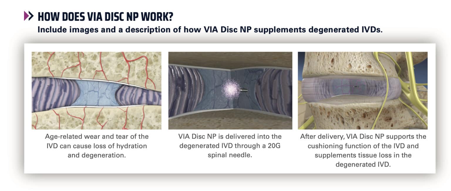 ViaDisc Procedure - The Southeastern Spine Institute